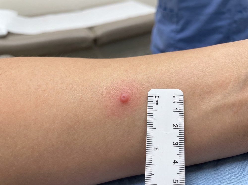 Close-up photo of a fresh assassin bug bite showing a raised red welt with a central puncture mark